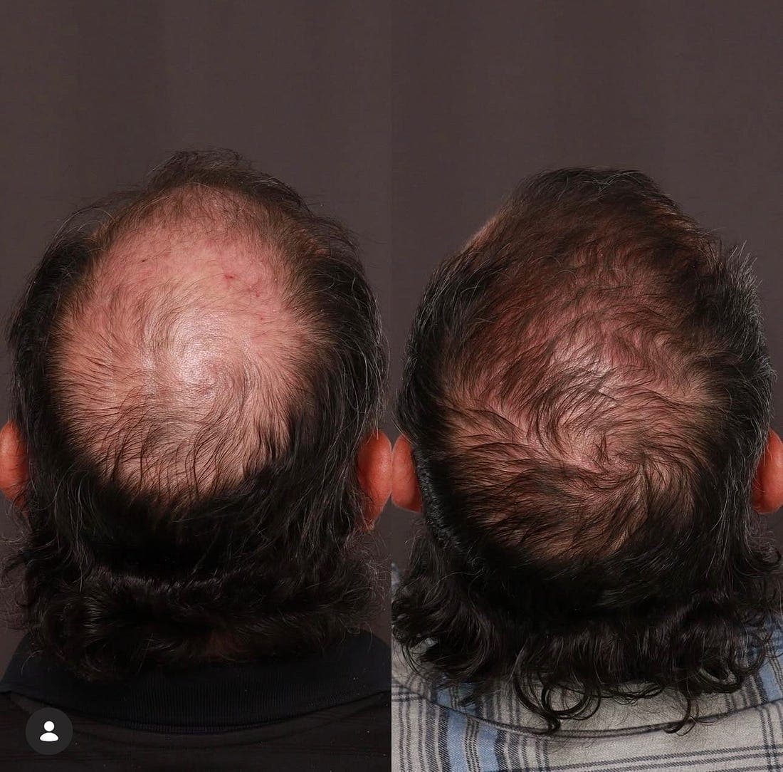 Before-and-after comparison of a patient's scalp showing increased hair density after treatment with topical finasteride and minoxidil.