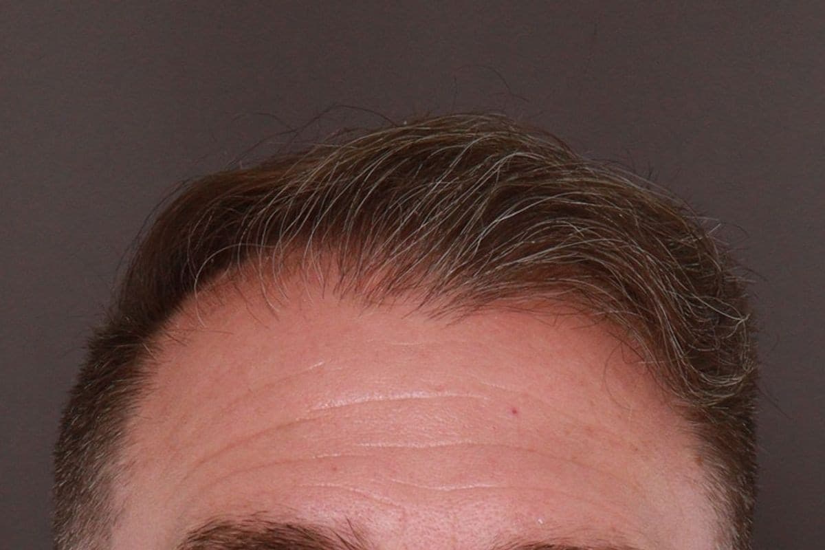 Before photo — FUE Transplant focused on the frontal scalp and vertex - 2 years post-op, Manning Facial Plastic Surgery.