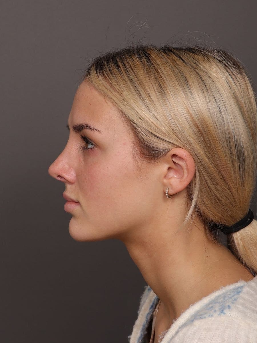 After photo — Open rhinoplasty at 1 year post-op, Manning Facial Plastic Surgery.