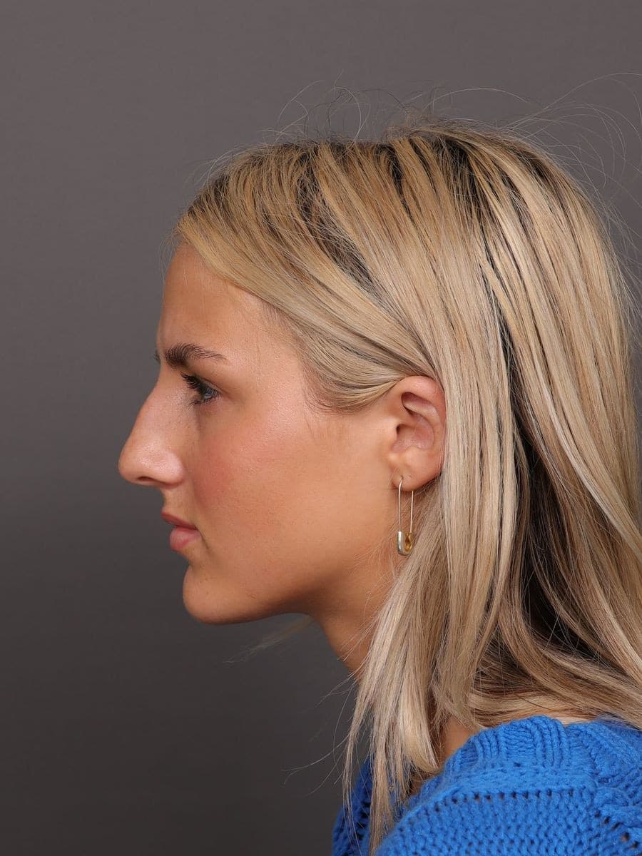 Before photo — Open rhinoplasty at 1 year post-op, Manning Facial Plastic Surgery.