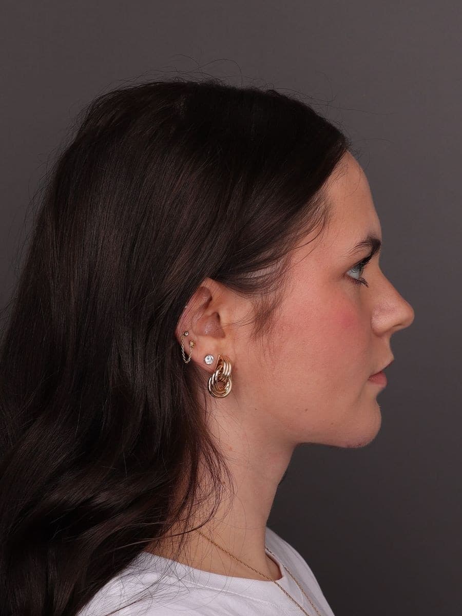After photo — Deep neck contouring with chin implant - 6 months post-op, Manning Facial Plastic Surgery.