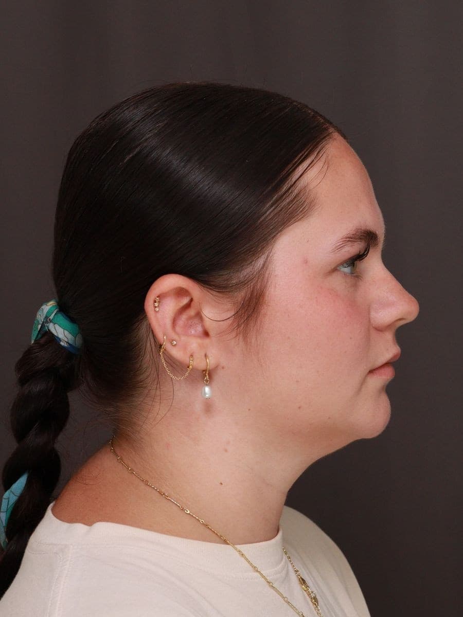 Before photo — Deep neck contouring with chin implant - 6 months post-op, Manning Facial Plastic Surgery.