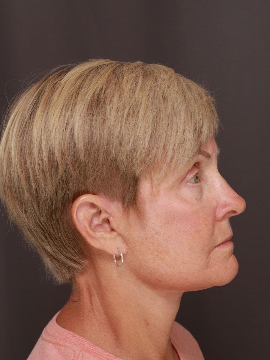 After photo — Deep plane facelift and necklift with lower blepharoplasty - 6 months post op, Manning Facial Plastic Surgery.