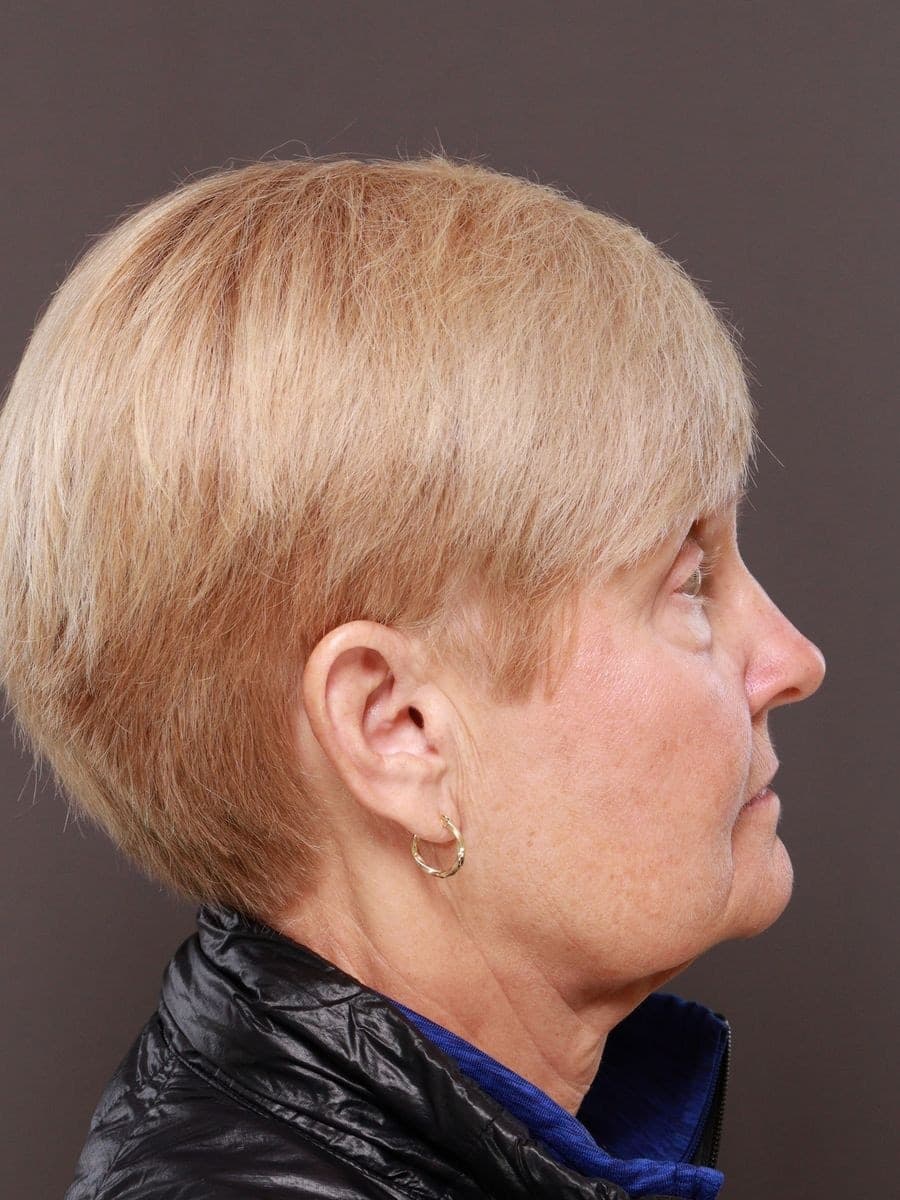 Before photo — Deep plane facelift and necklift with lower blepharoplasty - 6 months post op, Manning Facial Plastic Surgery.