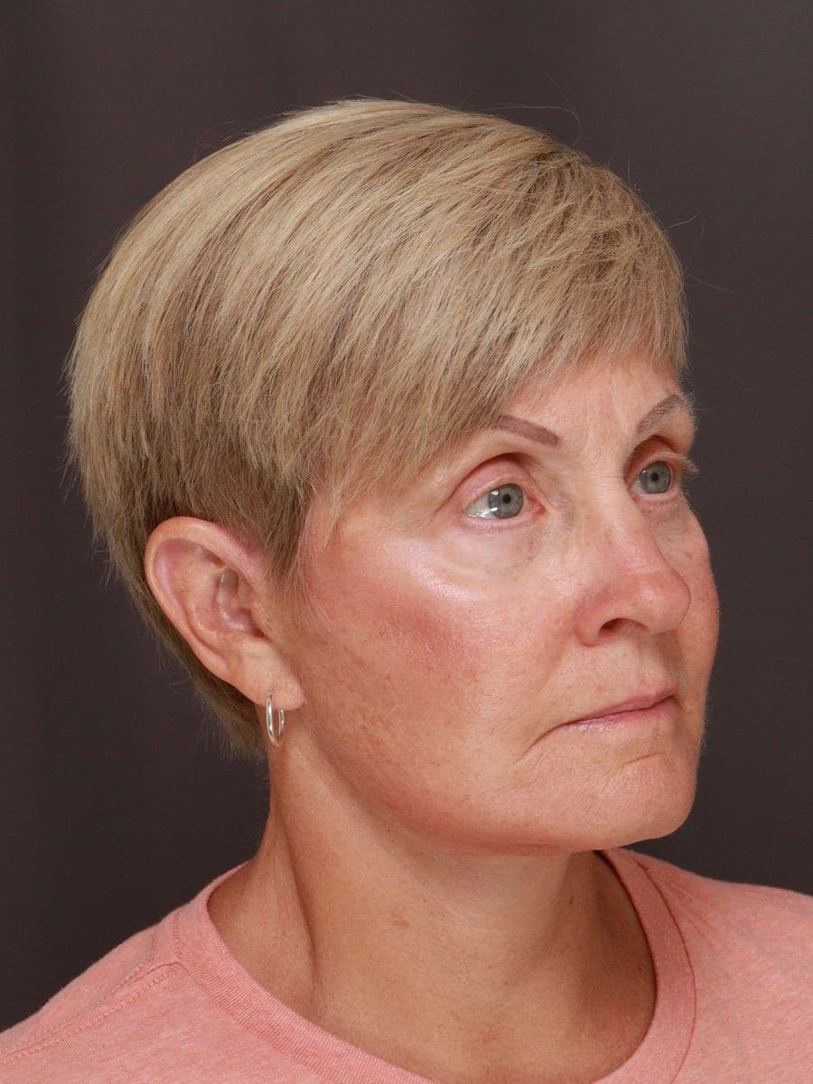 After photo — Deep plane facelift and necklift with lower blepharoplasty - 6 months post op, Manning Facial Plastic Surgery.