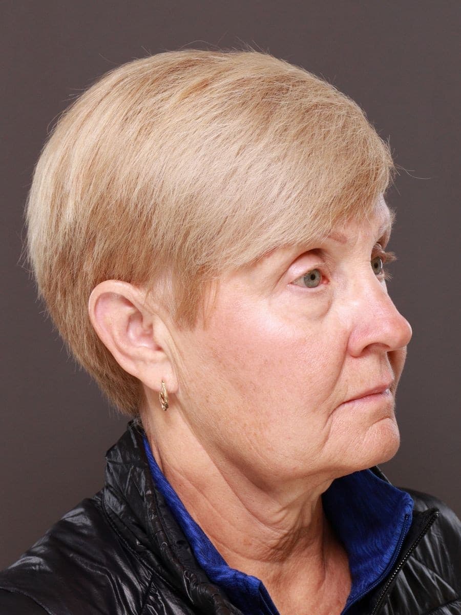 Before photo — Deep plane facelift and necklift with lower blepharoplasty - 6 months post op, Manning Facial Plastic Surgery.