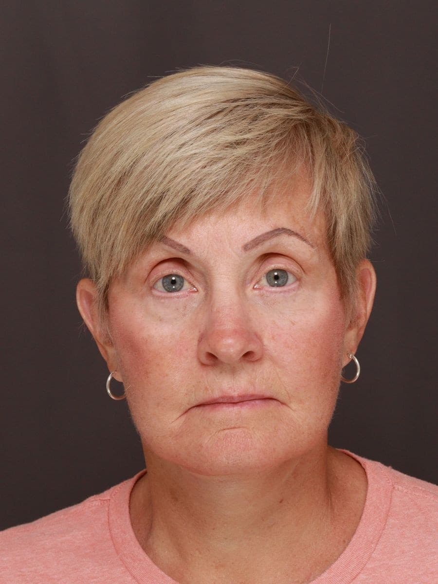 After photo — Deep plane facelift and necklift with lower blepharoplasty - 6 months post op, Manning Facial Plastic Surgery.