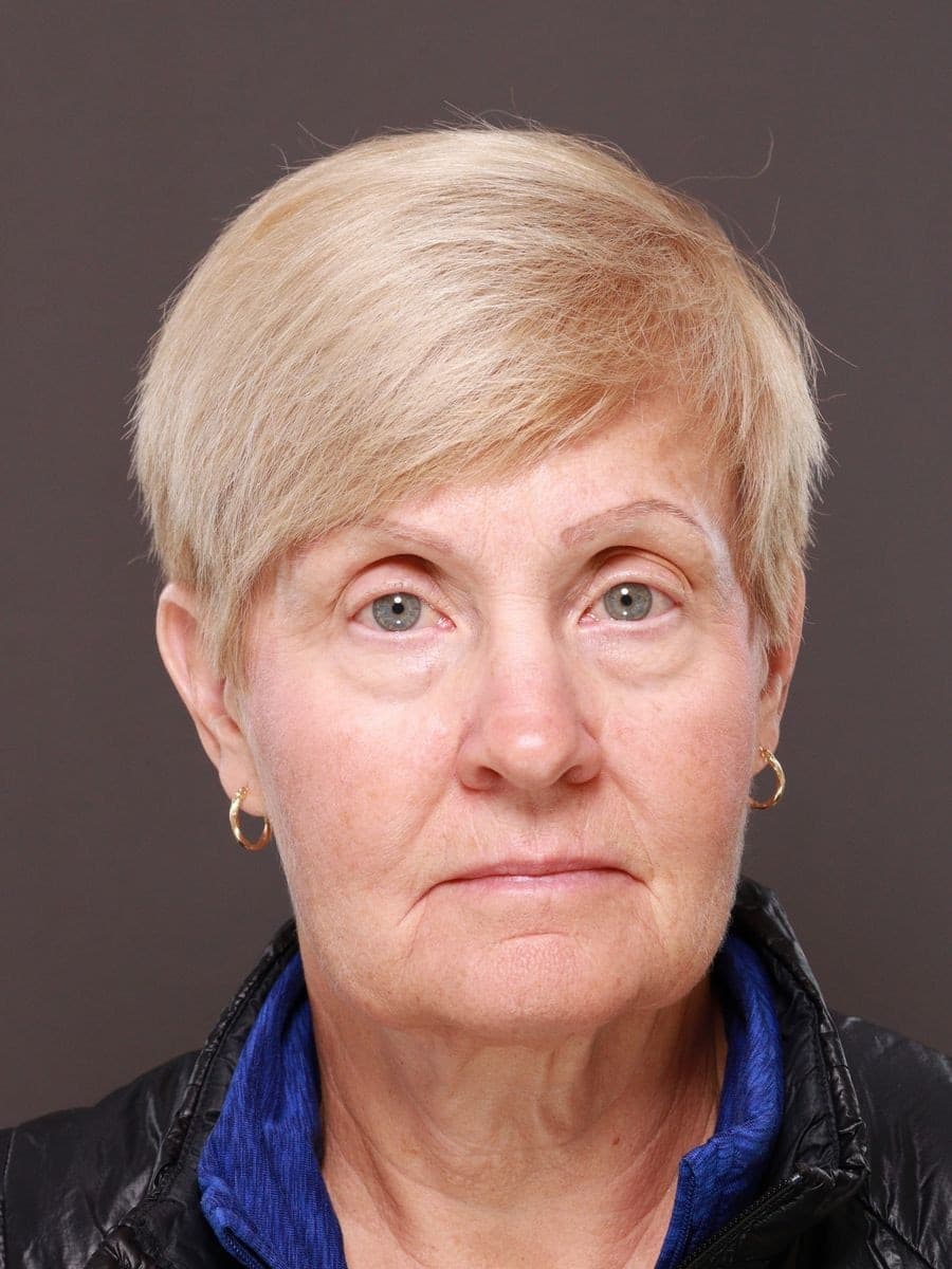 Before photo — Deep plane facelift and necklift with lower blepharoplasty - 6 months post op, Manning Facial Plastic Surgery.