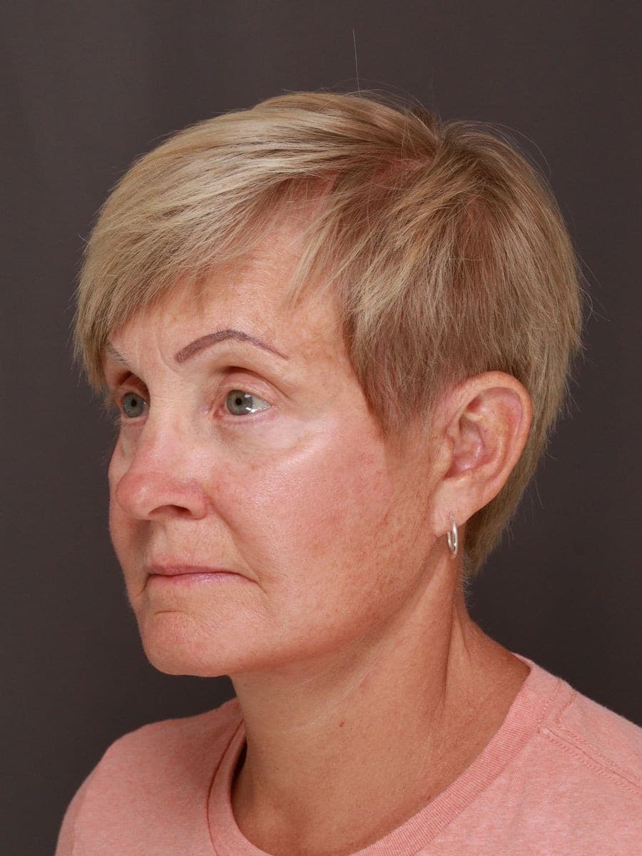 After photo — Deep plane facelift and necklift with lower blepharoplasty - 6 months post op, Manning Facial Plastic Surgery.