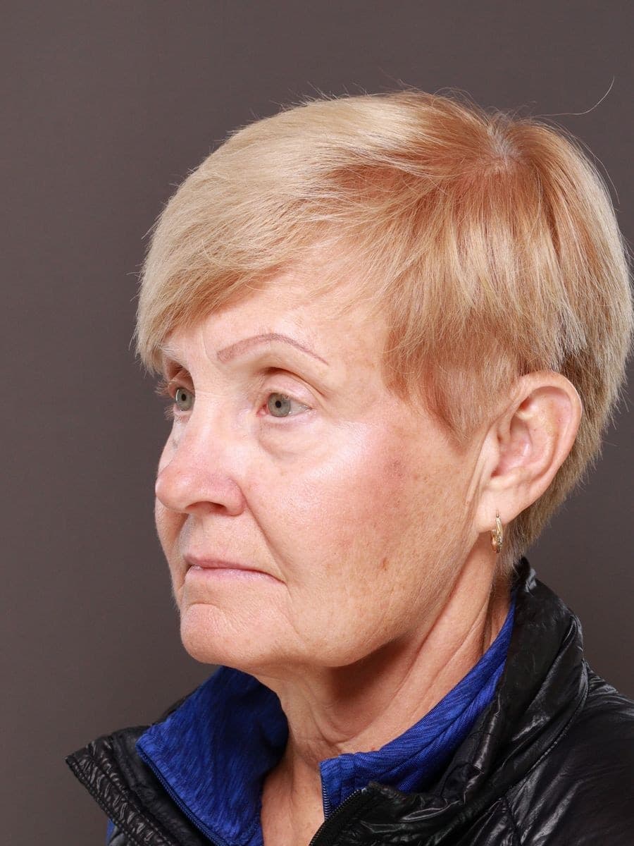 Before photo — Deep plane facelift and necklift with lower blepharoplasty - 6 months post op, Manning Facial Plastic Surgery.