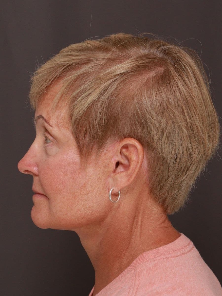 After photo — Deep plane facelift and necklift with lower blepharoplasty - 6 months post op, Manning Facial Plastic Surgery.