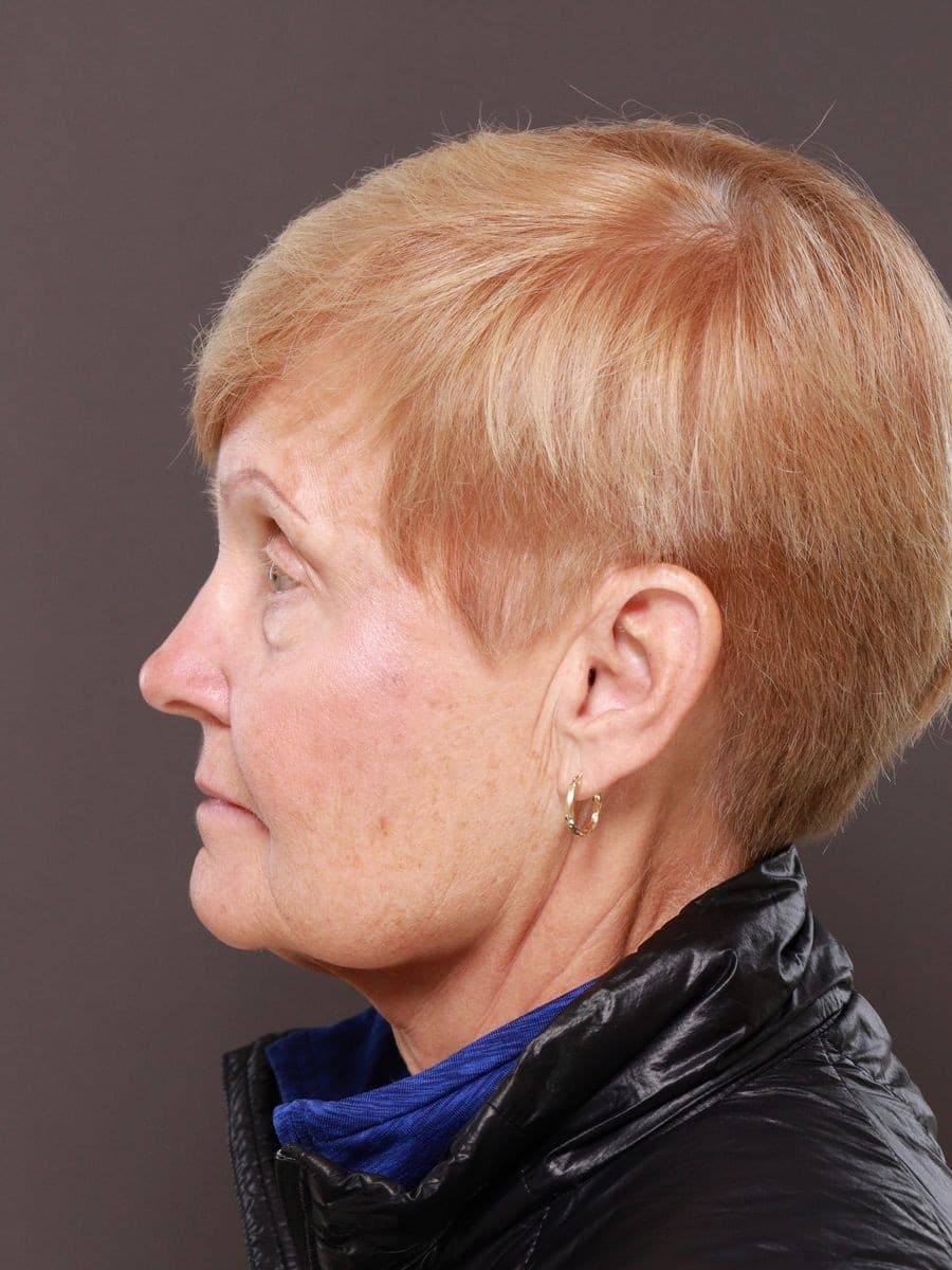Before photo — Deep plane facelift and necklift with lower blepharoplasty - 6 months post op, Manning Facial Plastic Surgery.